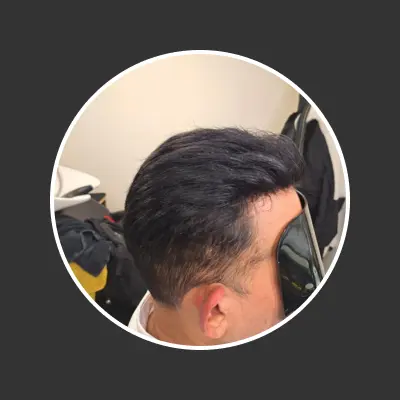 After hair replacement 1