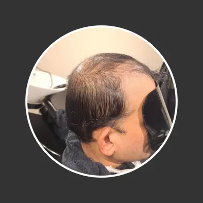 Before hair replacement 1