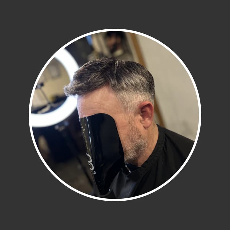 After hair replacement 2