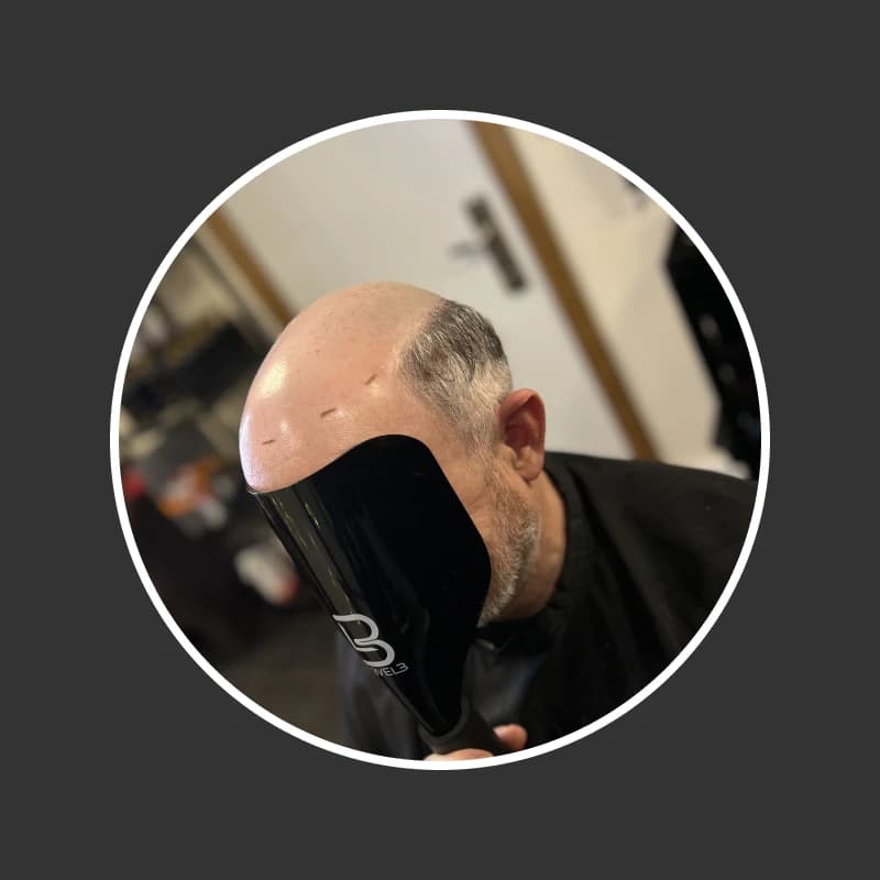 Before hair replacement 2
