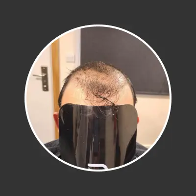 Before hair replacement 3